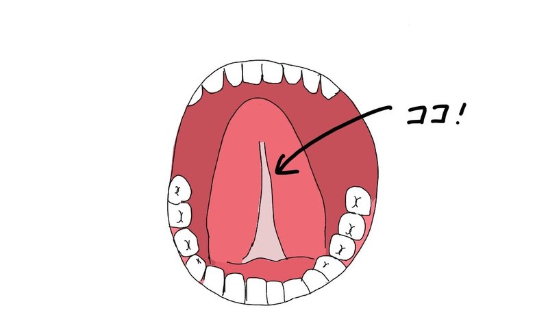 流暢な日本語を目指して舌小帯を切った話 くろうす Note