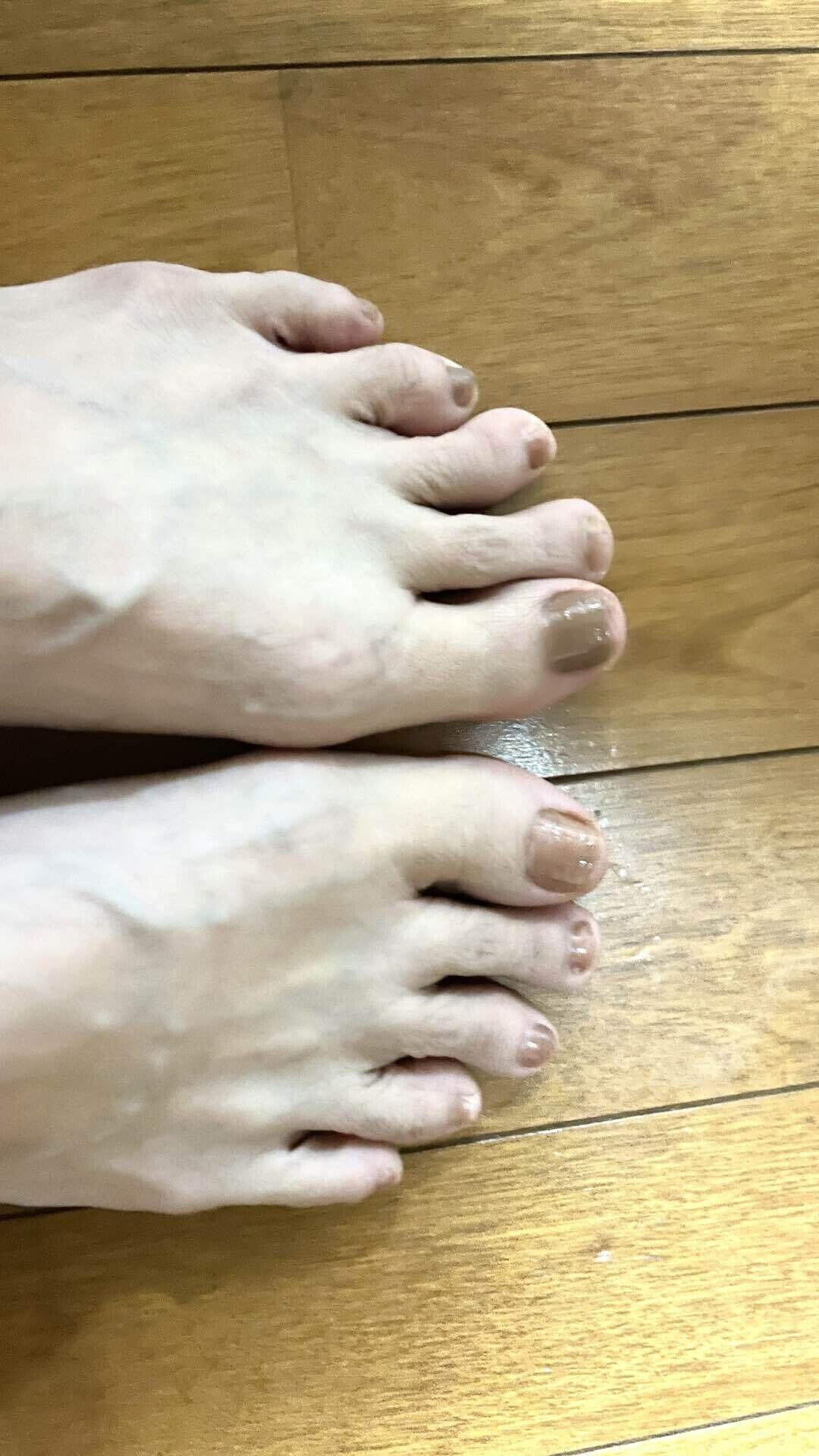 昔骨折した足の小指の件｜なゆた