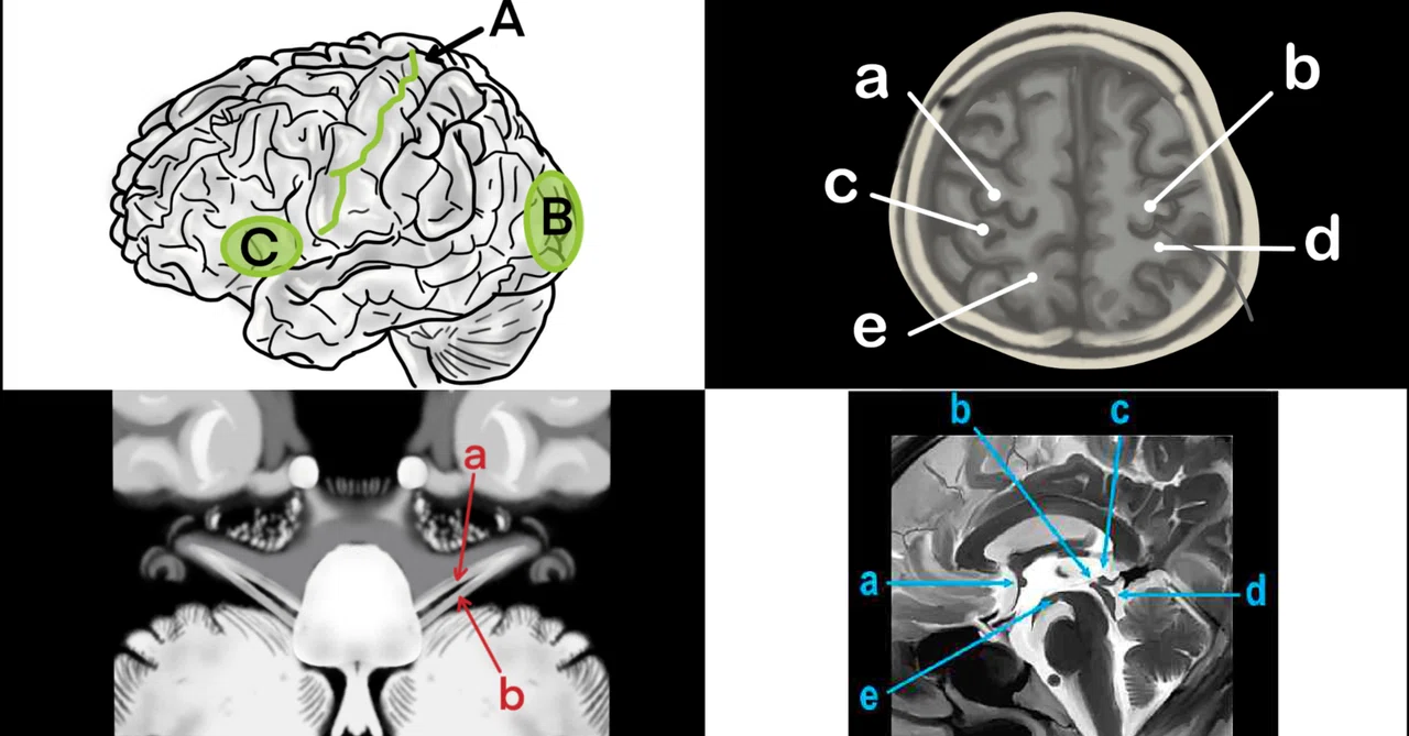 頭部解剖・読影｜MRI認定試験対策ノート