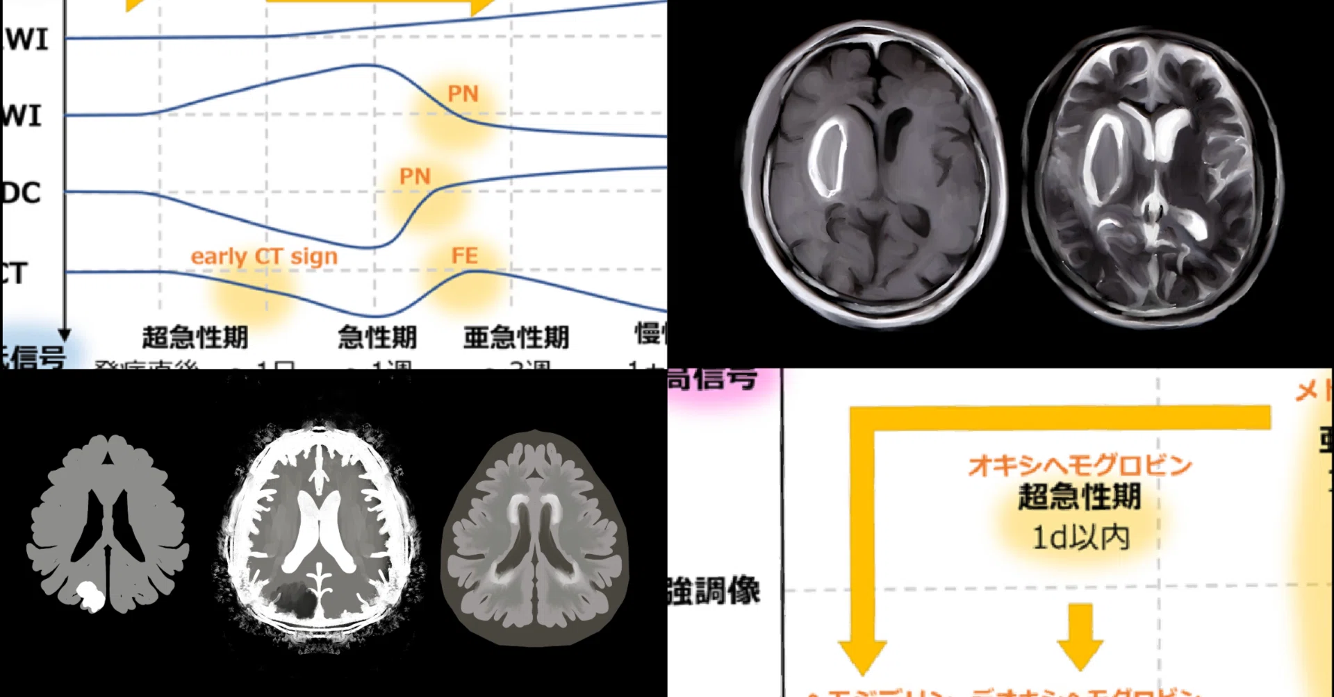 頭部疾患と撮像技術（脳卒中）｜診療放射線技師の認定試験対策ノート