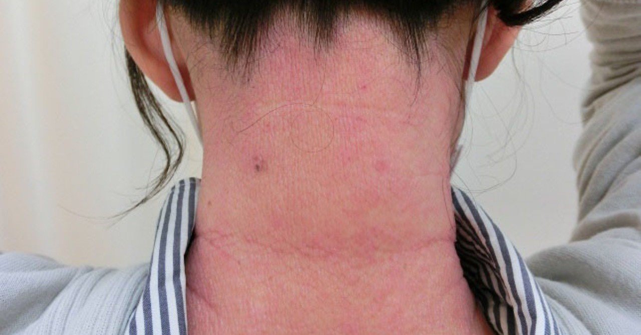 脂漏性皮膚炎のナゾ アレルギーとたたかう理学療法士 及川文宏 Note
