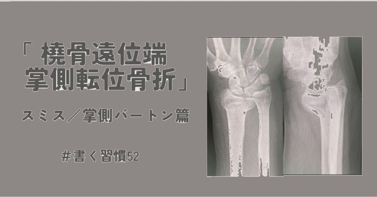 橈骨遠位端掌側転位骨折（Smith／掌側Barton篇）」#書く習慣52
