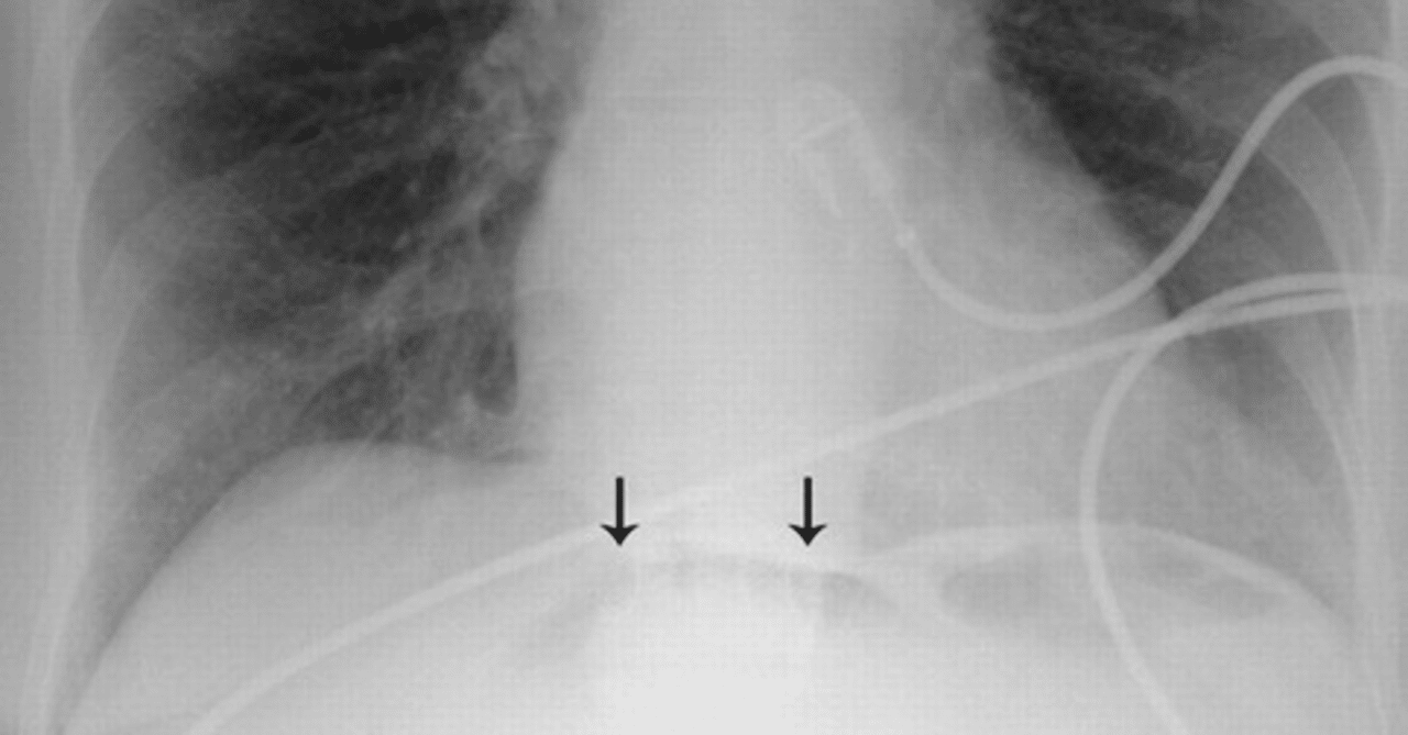 cupola sign|TKG画像診断|note