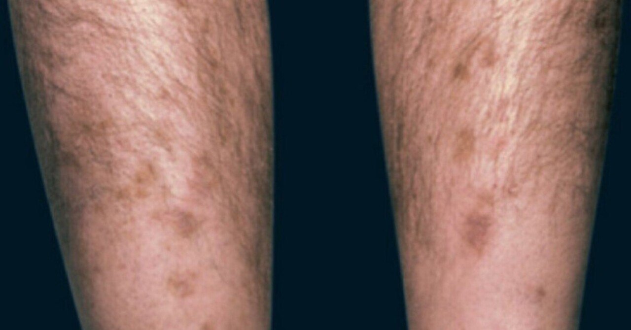 糖尿病性足潰瘍の原因