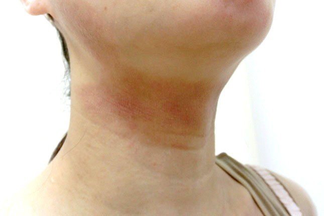 顔の湿疹と首の血流の関係性 アレルギーとたたかう理学療法士 及川文宏 Note